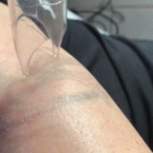 Winter Park Tattoo Removal