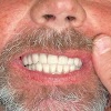 Tampa Dental Implants gallery