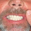 Tampa Dental Implants - Prosthodontists & Denture Centers