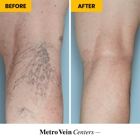 Metro Vein Centers | Long Island, Merrick