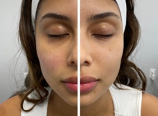 The 2-Minute Rule for Skin Tightening, Botox And Lip Fillers By Skinsation La thumbnail