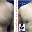 Boston Gynecomastia Specialists