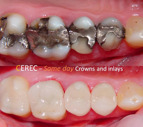 Sundial Dental Taree - Taree, NSW. Cerec crowns