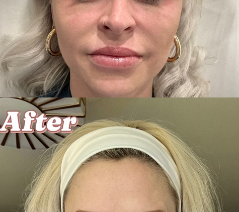 4ever Young STL - St.Louis, MO. Before and After Botox and Lips Fillers