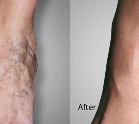 Advanced Varicose Vein Treatments of Manhattan - New York, NY