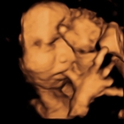 BabyImage 3D/4D Ultrasound