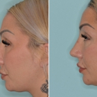 Facial Plastic Surgery Miami