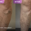 Vein Treatment Clinic | Spring Branch gallery