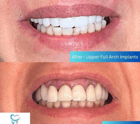 Tampa Dental Implants - Tampa, FL