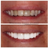 Dental Veneers Specialist On Wilshire - Los Angeles Cosmetic Dentist gallery