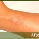 Skin Renew Day Spa & Laser Center - Tattoo Removal