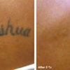 Eraser Clinic Laser Tattoo Removal gallery