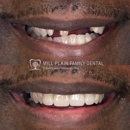Mill Plain Family Dental - Implant Dentistry