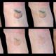 Removery Tattoo Removal & Fading