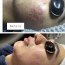 Clear Beauty Acne Clinic - Skin Care