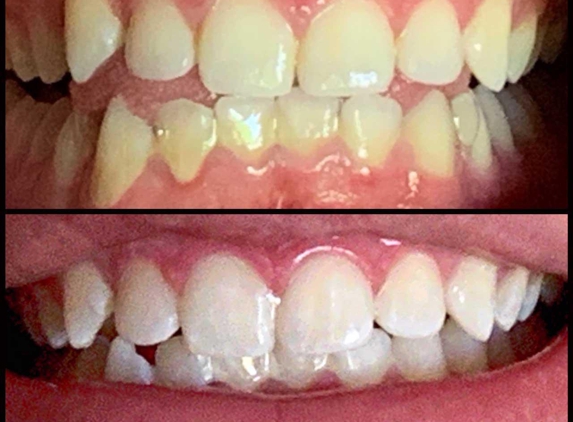 Carte Blanche Teeth Whitening - Pasadena, CA