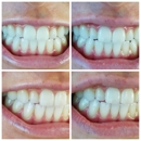 SmileLABS of Ankeny, LLC - Teeth Whitening Products & Services
