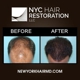 NYC Hair Restoration