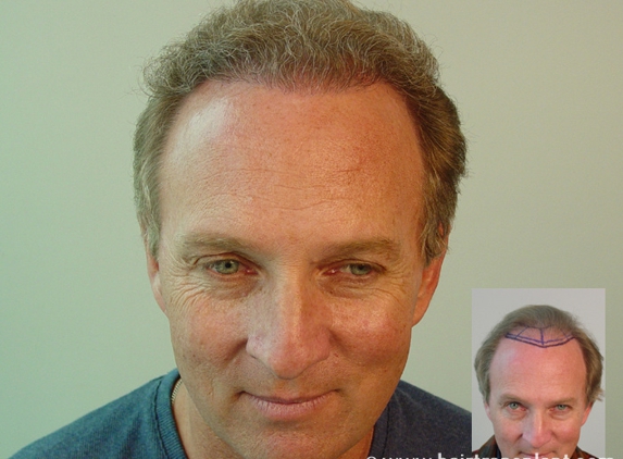 Natural Hair Transplant Medical Center - Newport Beach, CA