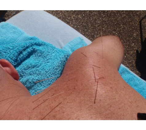 Body And Mind - Mudgeeraba, QLD. Dry Needling Shoulder