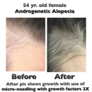 Tere Pruett Trichologist - Hair Replacement
