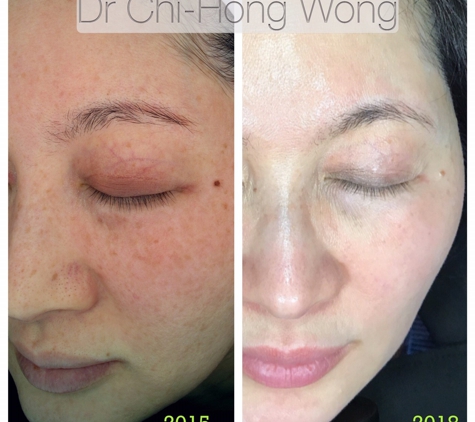 Cosmetic Laser & Skin Cancer Centre - Brendale, QLD. Before and After Laser treatment for Pigmentation, Melasma, Redness