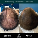 Vantis Institute - Hair Replacement