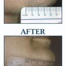 Idaho Dermatologic Surgery & Laser Center - Tattoo Removal