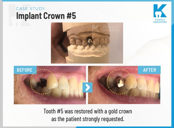 K Family Dentistry General Cosmetic Emergency Implants - Pflugerville, TX