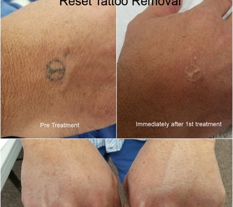 Reset Tattoo Removal - Las Vegas, NV