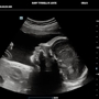 Peek a Boo Baby 3D 4D Ultrasound