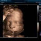 Baby Bee 3D Ultrasound (Fort Worth)